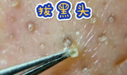 粉刺视频,视频教你轻松应对